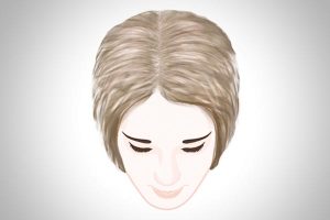 Pantogar® : Types of female hair loss